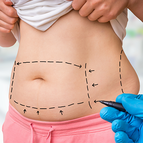 TUMMY TUCK