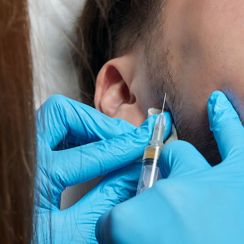 BEARD TRANSPLANTATION