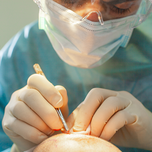 HAIR TRANSPLANTATION WITHOUT SHAVING