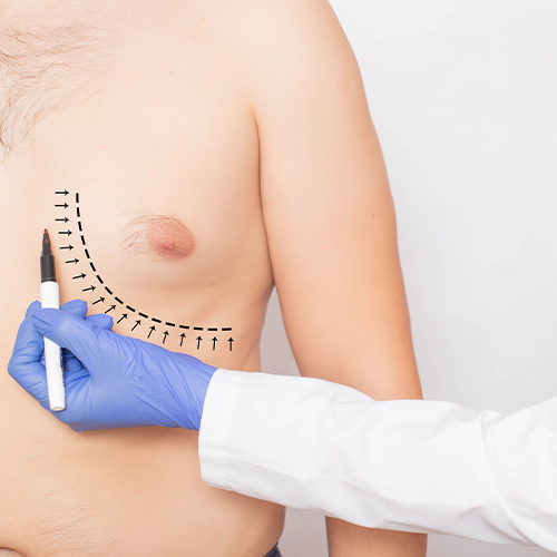 GYNECOMASTIA